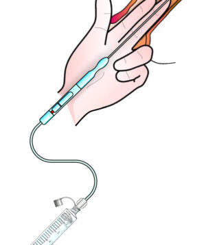 Dispozitiv pentru bloc paracervical uterin - steril